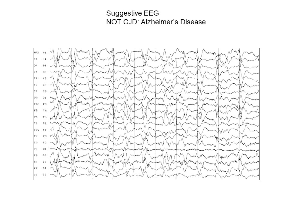 Suggestive EEG NOT CJD Alzheimer’s Disease CreutzfeldtJakob
